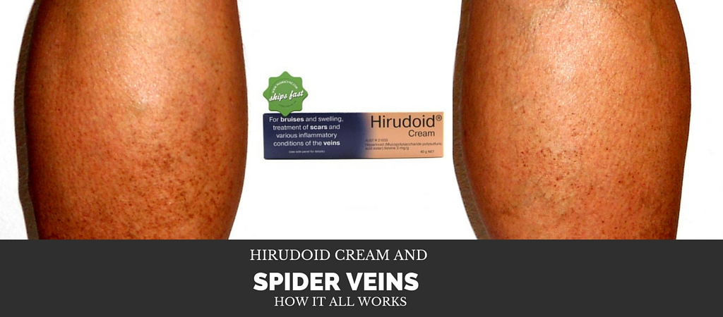 Hirudoid Cream and Spider Veins