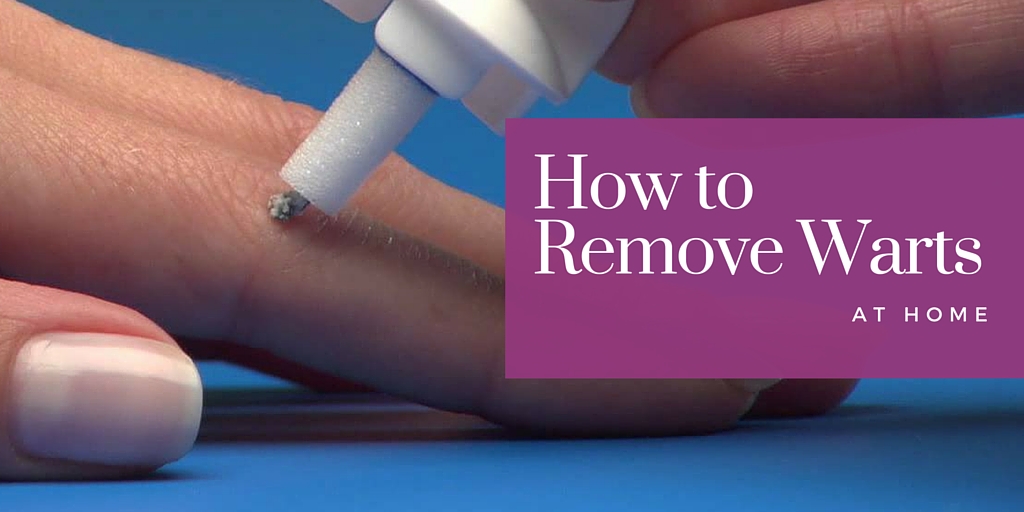 Your Guide To Home Wart Treatments in New Zealand