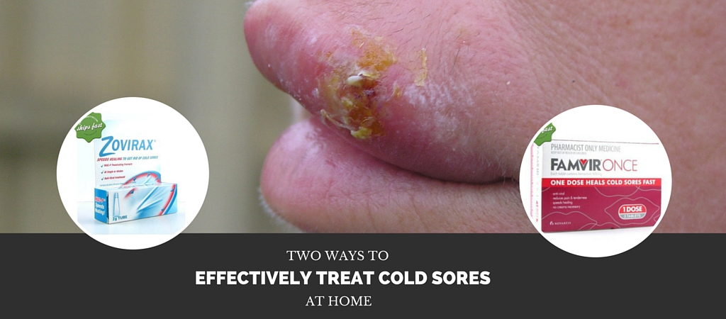 2 Ways to Effectively Treat Cold Sores
