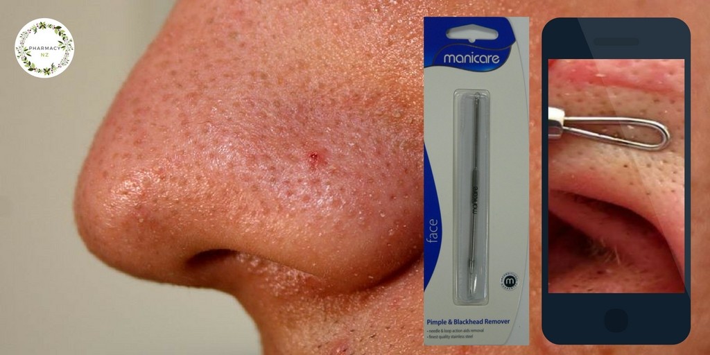 The Best Blackhead Remover so you can Stop Picking Your Face!