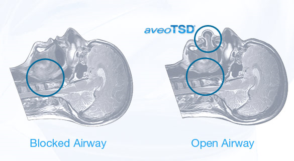 mri aveotsd